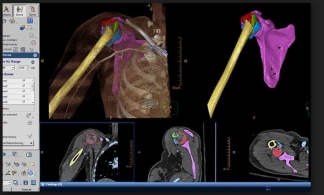 Philips IntelliSpace IX/LX Workstation for CT Trauma
