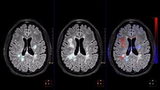 Philips IntelliSpace Portal for MRI Neuro