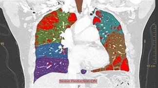 Philips IntelliSpace IX/LX Workstation for CT Pulmonary