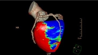 Philips IntelliSpace IX/LX Workstation for CT Cardiac